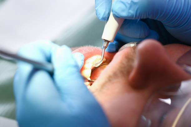 Best Emergency Dentist for Lost Fillings or Crowns in Old Tappan, NJ